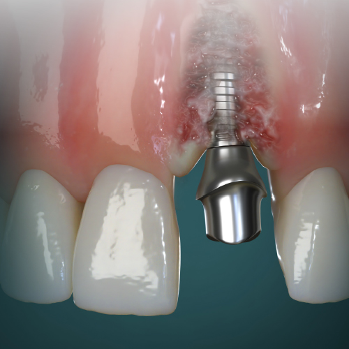 Current Strategies in Implantology eBook Thumbnail