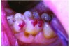 Figures 2 and 3. Abfraction lesions present on teeth with heavy indicator
markings. The marks indicate large contact areas present on the
cusp inclinations rather than the ideal small contact points on the cusp
tips. Reprinted with permission from Dr. Robert Palmer, DDS.