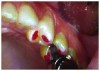 Figure 6. Heavy indicator
markings on cuspal inclines
tooth #12 (slightly rotated).
Note gingival cleft and beginning
of abfraction lesion. Patient
was experiencing sensitivity.
Reprinted with permission
from Dr. Robert Palmer, DDS.