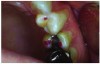 Figure 7. Heavy indicator
markings on cuspal inclines
tooth #12 (slightly rotated).
Note gingival cleft and beginning
of abfraction lesion. Patient
was experiencing sensitivity.
Reprinted with permission
from Dr. Robert Palmer, DDS.