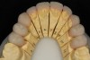 Figure 26  View of the lingual aspect of the fitted IPS e.max restorations on the master dies.