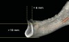 Figure 4  The mandible must be at least 10 mm in superior–inferior dimension. Rarely are mandibles of less than 10 mm observed clinically.