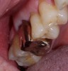 Fig 14. A patient presented with a defective gold crown on tooth No. 3 with mesial decay.