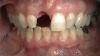 Fig 1. A female patient presented missing tooth No. 8, which would be replaced with a single implant restoration.
