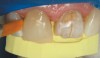 Fig 14. Completed restoration of tooth No. 8 MIFL. The next step is to finish and polish tooth No. 8 before restoring tooth No. 9 using the same VPS custom lingual guide.
