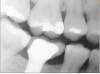 Fig 3. Implant-supported restoration with improper contacts and contours adjacent to a toothborne restoration that was prepared with insufficient margin depth, lending to “potbelly” type of contact.
