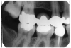 Figure 1 - Defective Restoration; Abutment Tooth #4