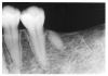 Figure 20 - Residual Tooth Fragment