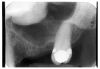 Figure 61 - Radiographic image of Maxillary Torus