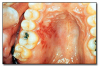 Fig 35. Recurrent herpetic lesion.