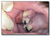 Fig 50. Periodontal abscess.