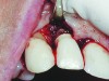Fig 1. This implant was placed in March 2006. Peri-implantitis was clinically evident in April 2008, with bleeding on probing, suppuration, and increasing probing depth.