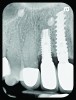 Fig 5. Radiograph 6 years after peri-implantitis repair (2014).