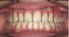 Figure 2   A balanced appearance of the anterior teeth is represented by a "golden proportional" of 1.618 for the maxillary central incisor, 1 for the lateral incisor, 0.618 for the canine.