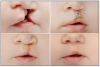 Figure 9. Cleft lip and palate.