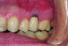 Buccal soft tissue recession which occurred 1 year following completion of the implant restoration is another example of a reversible complication.