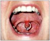 Figure 2. Uvula piercing.