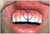 Figure 8. Smiley piercing.
