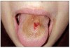 Figure 19. Infection at the piercing site.