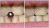 Figure 22. Tooth abrasion.