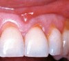 Figure 1—Gingival recession. Gingival recession leads to exposed dentin. If the dentin tubules are open to the oral cavity, dentin hypersensitivity will likely occur. The differences between sensitive and non-sensitive dentin are not apparent to the naked eye. Image courtesy of Li.