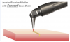 Figure 2 Incision/excision/ablation with a focused laser.