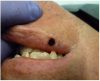 Figure 14 The immediate postoperative view. A thin layer of char was created as a precautionary measure to protect the surgical site. No sutures were placed and the surgical wound was left to heal by secondary intention.