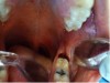 Fig 10. Excellent hemostasis after the completed ablation of the inflamed gingiva.