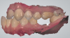 Fig 7. Intraoral scan data of buccal bite, showing upper arch, lower arch, and implant.