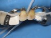 Figure 23 through Figure 25 Rubber dam isolation for the insertion of the veneers, isolating two teeth at a time starting with the maxillary central incisors.