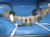 Figure 31 through Figure 33 Rubber dam isolation for the insertion of the veneers, isolating two teeth at a time starting with the mandibular central incisors and then moving over to isolate the next two adjacent teeth.