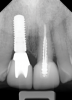 Fig 12. In a separate case, radiograph of implant No. 8 is shown. Previous endodontically treated tooth had fractured and the decision was made within a few months to extract and replace it with an implant. Bone was preserved to optimize the implant site.