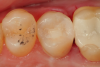 Fig 8.	An occlusal view of the completed composite restoration of tooth No. 13.