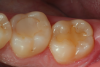 Fig 10. A preoperative occlusal view of tooth Nos. 18 and 19 with composite restorations that are exhibiting marginal breakdown.