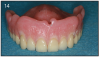 Figure 14 – Overdenture with flange to restore lip support