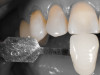 Fig 2. A shade is taken of the unprepared tooth and photographed in isolate shade mode with an EyeSpecial II dental camera (Shofu Dental).