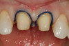 Fig 3. A retraction cord is placed in preparation for the registration of master impressions.