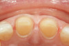 Fig 10. An incisal view of the preparations and gingival tissues. Note the health of the sulcular epithelium due to the precise fit and emergence profiles of the provisional restoration.