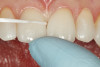 Fig 18. Dental tape is used to access final cement removal prior to full light curing.