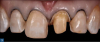 Fig 3. Preparation of the teeth with minimal reduction in this patient involved removal of the feldspathic crown and of minor interproximal decay on the anterior teeth, so that the restorative margins would be on sound tooth structure, preferably enamel.