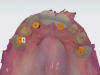 Fig 12. The CBCT and virtual wax-up plan were merged together, and virtual implant placement was done; frontal view (Fig 11), and occlusal view (Fig 12).