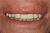 Fig 22. The zirconia provisional restoration replicated the patient’s pretreatment restoration.