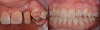 Fig 12. Left panel: temporary abutment in the patient with the congenitally missing tooth No. 10. Right panel: Two weeks postoperatively after the implant and connective tissue graft placement. (Images courtesy of Dr. Keith Progebin.)