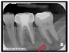 Fig 3. Periapical taken 5 months after Figure 1. Moth-eaten borders and apical root resorption affecting and surrounding tooth No. 18.