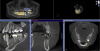 Fig. 1 The CBCT scan with the CAD/CAM data overlaid. The bone, soft tissue, and outline of the final restoration are seen in a single view.
