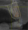 Fig. 5 and Fig. 6 The implant being placed virtually relative to available bone, soft tissue, and final restoration. In this case a screw-retained restoration was the goal and a buccal bone graft was planned prior to surgery. Because the surgery was planned and the area requiring grafting was known, a conservative flap sparing the papilla could be done.