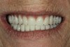 Fig 10. The final dentures.