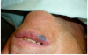Figure 5 Topical anesthetic was applied prior to administering local anesthesia.