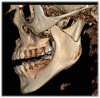 Figure 5. CBCT technology looks beyond the oral cavity to offer the clinician a broader picture that can be useful in diagnosing airway obstructions and disorders of the craniofacial and oropharyngeal anatomy.