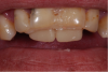 Fig 6. In Case 3, the denture teeth were bonded in place to determine the new incisal edge position of the central incisors.